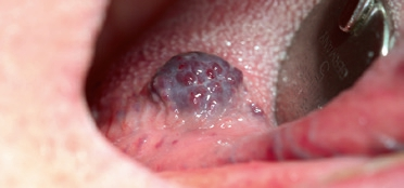 Abb. 6: Bläuliche Läsion, Hämangiom des hinteren rechten Zungenrandes.