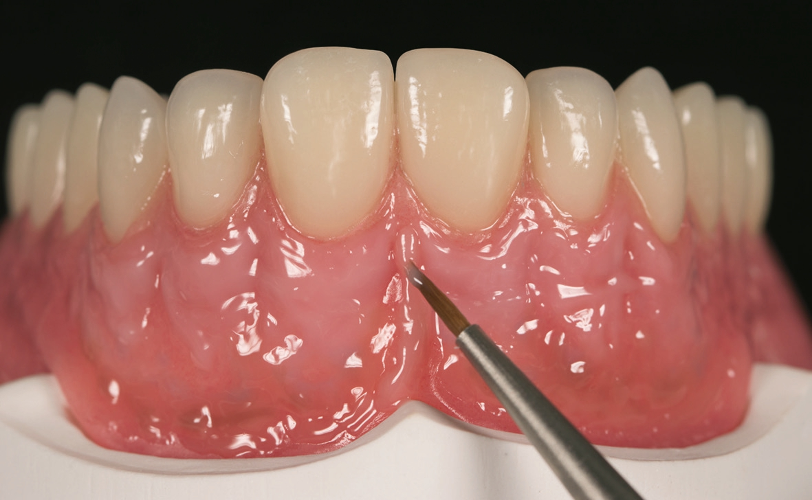 Abb. 6: Das Lippenbändchen wurde final mit hellerem VITA VM LC GINGIVA 1 rekonstruiert.