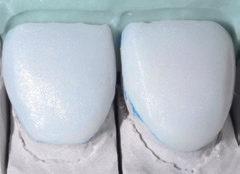 Abb. 6: Herstellung der Veneers in der Cut-back-Technik.