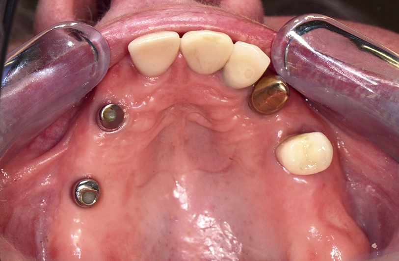 Abb. 3: Pfeilervermehrung im 1. Quadranten durch 2 Implantate (strategische Pfeilervermehrung).
