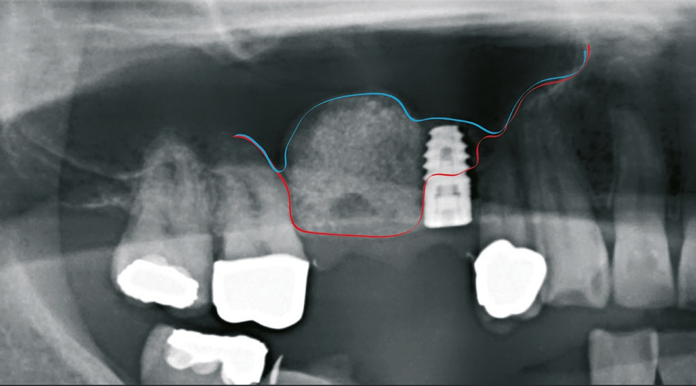 Abb. 6: OPG postoperativ.