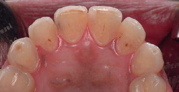 Abb. 6: Palatinale Ansicht eindeutig erosiv beeinträchtigter Oberkiefer-Frontzähne und Prämolaren. Testfrage: Welche ABS-Grade liegen Ihrer Beurteilung nach für die einzelnen Zähne jeweils vor?