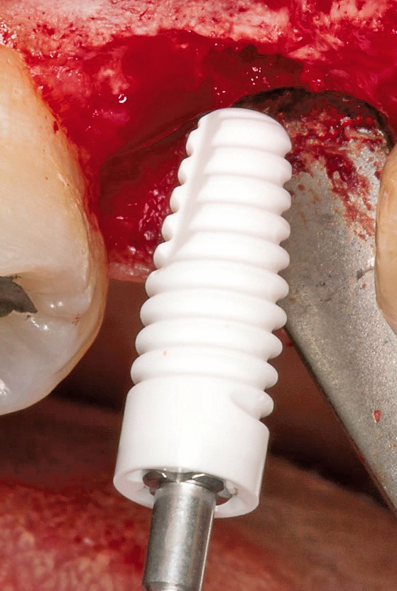 Ansicht vor Insertion eines 10 mm langen Keramikimplantates RB (Regular Base, 4,2mm DM) in regio 15.