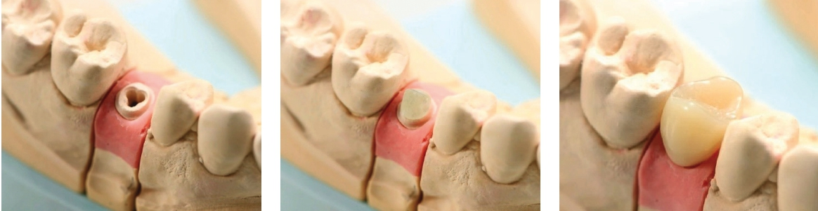 Abb. 6-8: Das Labor gießt das Modell in Superhartgips aus, fixiert den Glasfaser-Abutment-Aufbau und fertigt Krone.