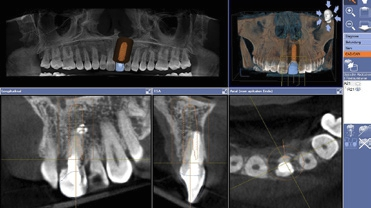 Abb. 5: Überlagerung der 3D-Röntgendaten mit dem intraoralen CEREC-Scan zur optimalen Positionierung des Implantats in der Planungssoftware Galileos Implant.