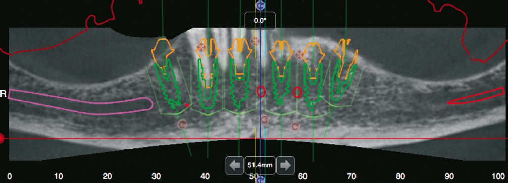 Abb. 5a: Positionierung der Implantat- und Abutmentachsen in sagittaler Schnittbildaufnahme.