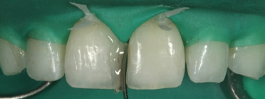 Abb. 6: Mithilfe eines lichthärtenden Provisorium-Materials mesial an Zahn 21 fixierte Teilmatrize.