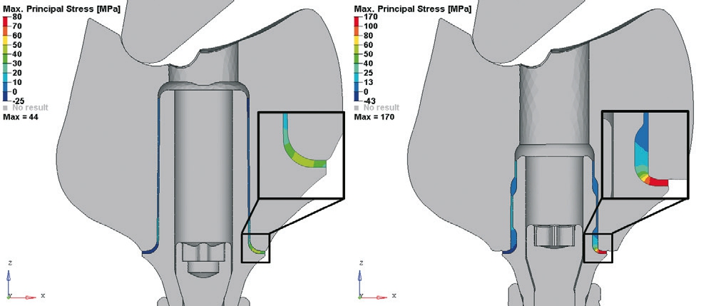 Abb. 5: FEM-Querschnitt: Restauration mit Viteo Base (li.) mit geringem Stress im Vergleich zu einer anderen Titanklebebasis (re.) mit erhöhter Stressneigung.