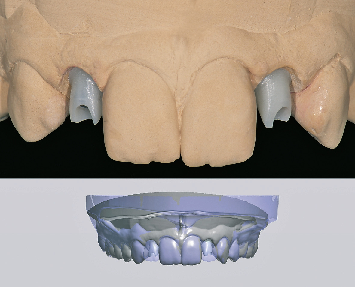 Abb. 6: Design und Umsetzung der Abutments.