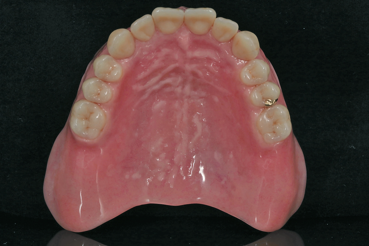 Abb. 6: Oberkieferprothese in der Gesamtansicht von okklusal.