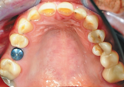 Abb. 29: Implantat mit Gingivaformer.