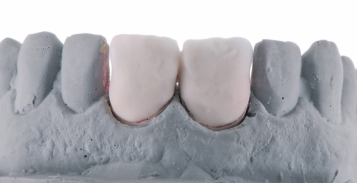 Abb. 6: Schichtung der Veneers für den ersten Brand.