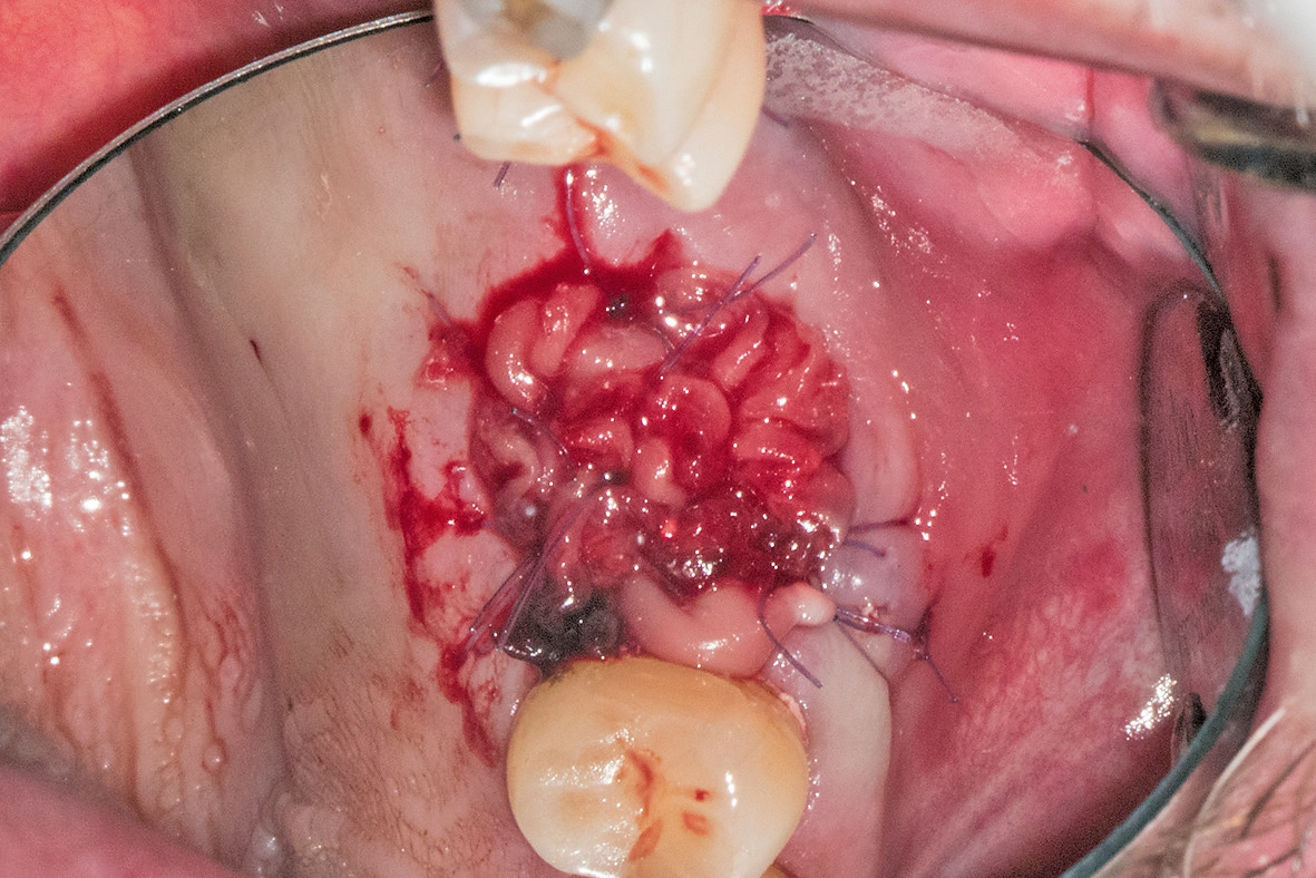 Abb. 6: A-PRF+Membranen zur Socket preservation.