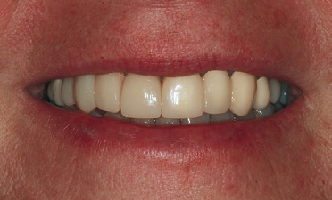 Abb. 6: CAD/CAM-gefertigtes Provisorium nach Smile Design-Planung.