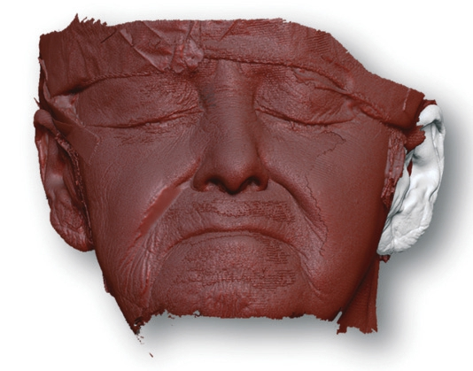 Abb. 5b: Das Spiegeln von der originalen Anatomie eines vorhandenen Ohres auf die Defektseite – „Mirror-imaging technique“. Zu erkennen sind auch Pflaster und Haube zum Abhalten der Haare für die störungsfreie Erfassung.