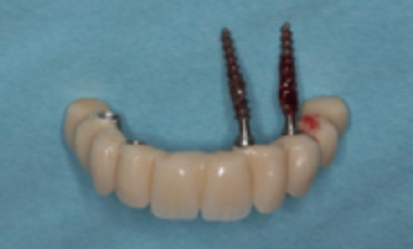 Abb. 6: Der Verlust zweier Interimsimplantate.