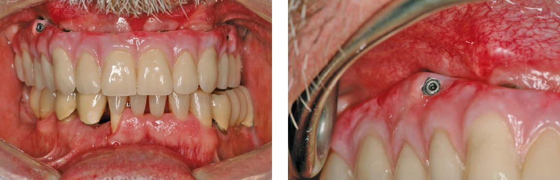 Abb. 7 und 8: Ansicht von vestibulär. Die Schraubenkanäle der posterioren Implantate sind im zervikalen Bereich „versteckt“.