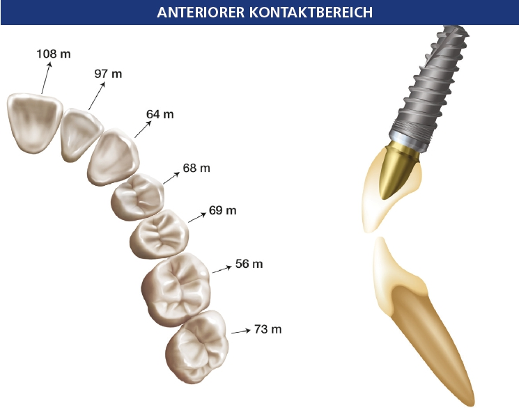 Abb. 4a: Die horizontale Bewegung der natürlichen Bezahnung bei Okklusalkontakt ist in der anterioren Region sehr viel größer als in der posterioren, wodurch für Einzelzahnimplantate ein erhöhtes Risiko für eine okklusale Überlastung entsteht. Daher sollte, hauptsächlich bei starkem Zubeißen, die Nicht-Existenz möglicher vorzeitiger Kontakte überprüft werden. Abb. 4b: Idealerweise sollte eine anteriore Einzelzahnkrone während einer starken Okklusion minimalen Kontakt und bei leichter Okklusion keinen Kontakt haben; ein vorzeitiger Kontakt kann die periimplantären Hart- und Weichgewebe schädigen. Zu beachten ist, dass die im Unterkiefer gegenüberliegende Höckerspitze bei Bedarf auf der fazialen Seite verändert werden kann.