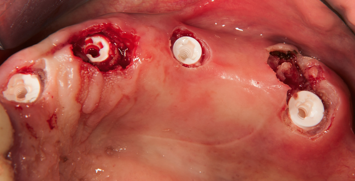 Abb. 6: Die freigelegten Implantate.