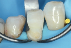 Abb. 6: Zahnoberfläche nach Ätzen mit Phosphorsäuregel.