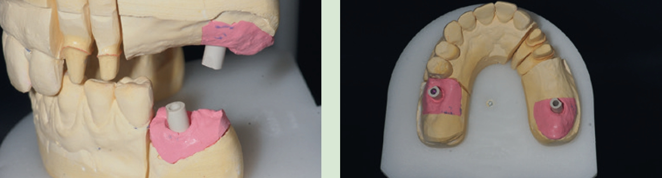 Abb. 10 u. 11: Fertige Meistermodelle mit Scanpfosten auf den Manipulierimplantaten.