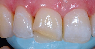 Abb. 6: Klassische Verarbeitung des Komposits. Unter Zuhilfenahme eines Silikonschlüssels (Flexitime, Kulzer) und Schichtung direkt auf den Schlüssel wird die palatinale Fläche mit einem opaken Flowable (Venus Diamond Opaque Medium Cromatic [OMC], Kulzer) aufgebaut.