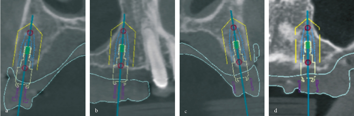 Abb. 6a–d: Implantatplanung mithilfe der Planungssoftware NobelClinician®.