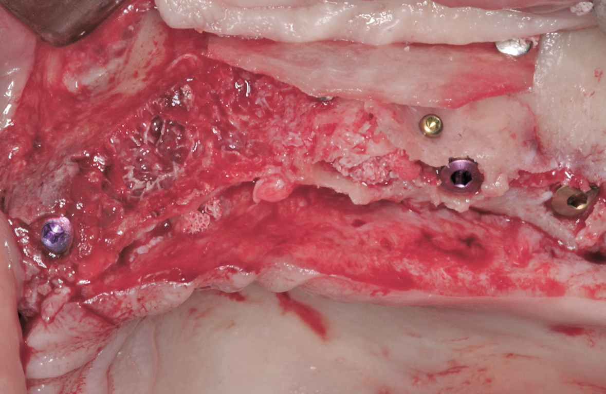 Abb. 6: Zustand nach Sinuselevation, laterale Augmentation mittels des gewonnenen Sinusfensters und Implantatinsertion.