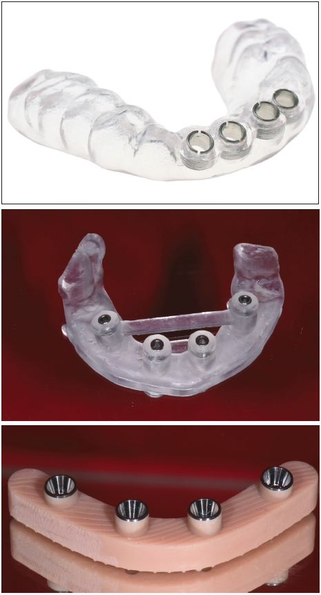 Abb. 6a–c: Versionen von 3D-gedruckten Bohrschablonen. Die Hülsen werden meist vor dem Lichthärten eingebracht. Das jeweilige Material muss auch bei dünnen Wandstärken verzugsfrei sterilisierbar sein.