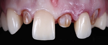 Abb. 3b: Frontzahnkronen aus Abb. 3a bei der Einprobe im Oberkieferfrontzahnbereich bei einem Patienten mit Dentinogenesis imperfecta.