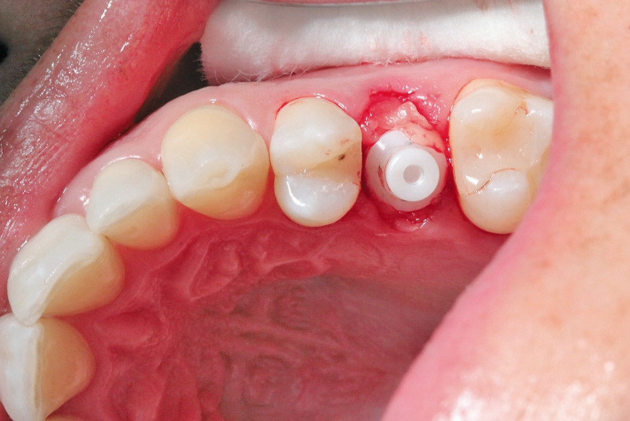 Abb. 6: PRF rund um das inserierte Implantat.