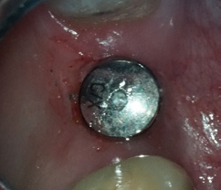 Abb. 9: Vorübergehende Versorgung mit einem Gingivaformer.