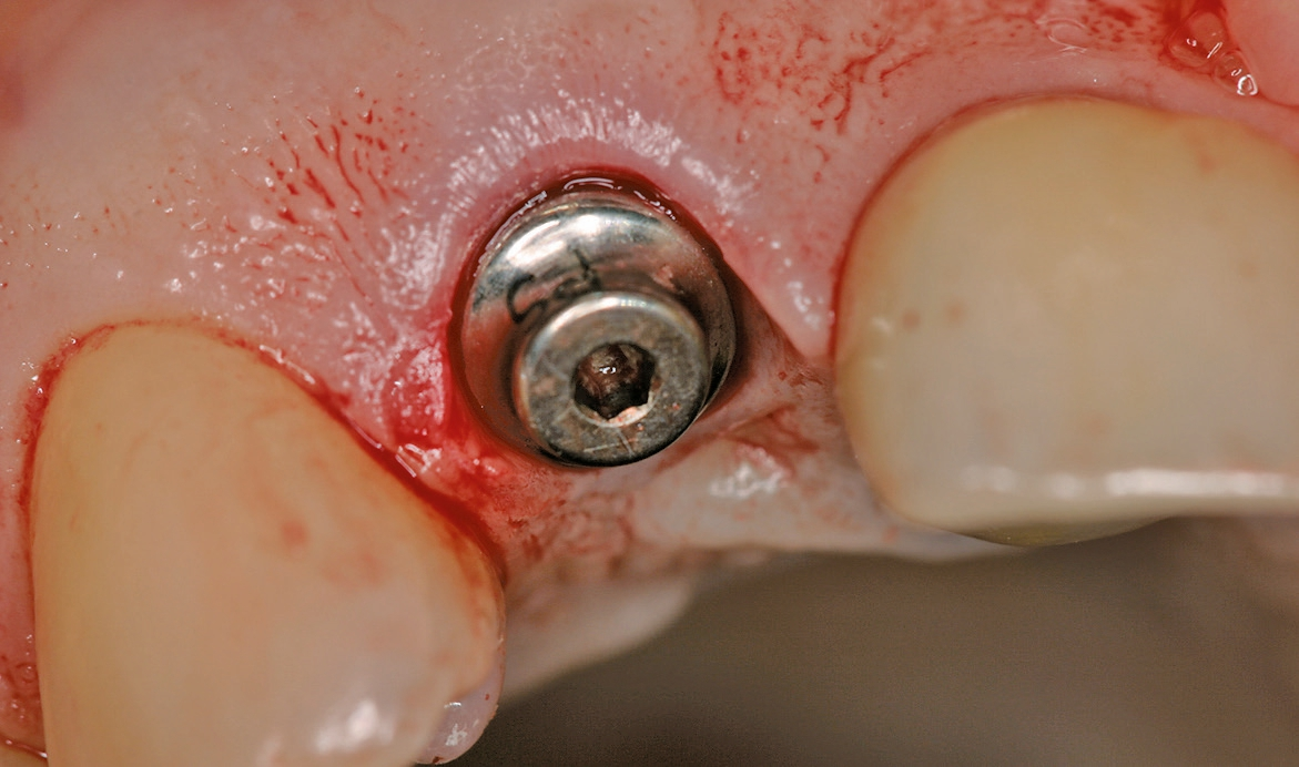 Abb. 6: Offene Einheilung mittels Bottleneck Gingivaformer.