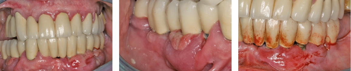 Abb. 6: Amlodipin assozierte Veränderung der periimplantären Mukosa (PSA s. Titelbild).