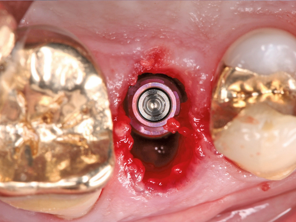 Abb. 6: Das 2 mm subkrestal und in palatinalem Bereich inserierte Implantat.
