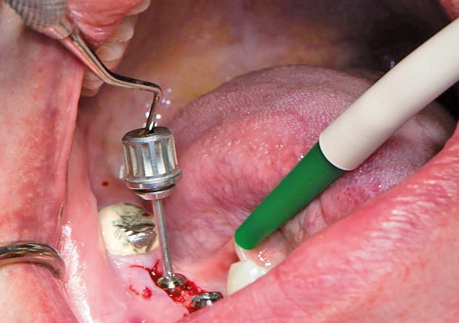 Abb. 6: Fixierung der Verkleidungsschraube nach erfolgter Verabreichung von GapSeal®.