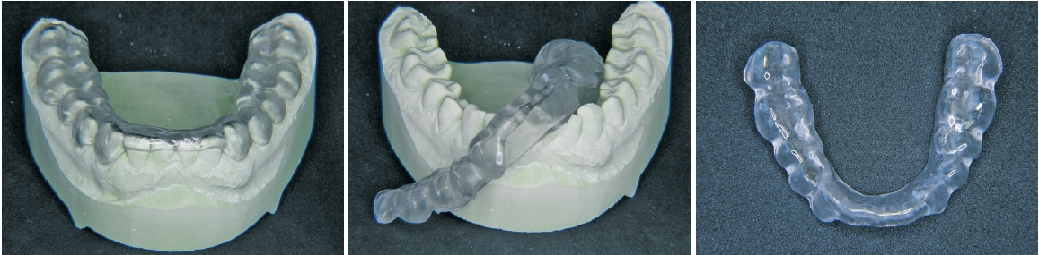 Abb. 6a–c: Aufbissschiene mit FREEPRINT® ortho 385.