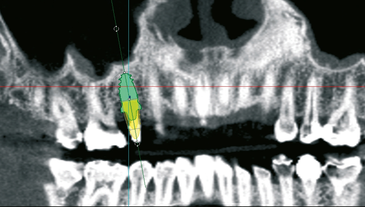 Abb. 6: In der Implantat-Planungs-Software wurde die Implantation simuliert.