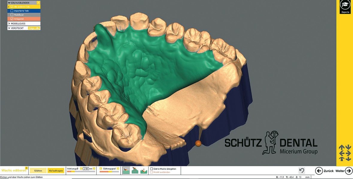 Abb. 6: Oberkiefer-Jig, in der Modellgusssoftware modelliert.