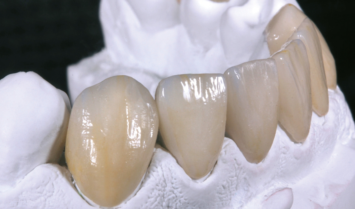 Veneers und Vollkronen aus VITA AMBRIA und VITA LUMEX AC zeigen eine optimale Passung und ein facettenreiches Farb- und Lichtspiel.