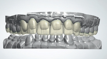 Abb. 7: Präparation und virtuelle Konstruktion (3shape) von Kronen, Teilkronen und Okklusal-Veneers.