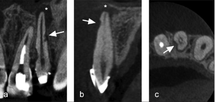 Abb. 6a–c: Der Zahn 22 erlitt ein starkes Intrusionstrauma und entwickelte daraufhin eine Pulpanekrose. In der DVT-Aufnahme nach 6 Monaten zeigt sich die bakterielle Infektion des Wurzelkanals als apikale Osteolyse (*). Das digitale Volumentomogramm bildet infektionsbedingte Resorptionen in allen 3 Ebenen ab (s. Pfeile).