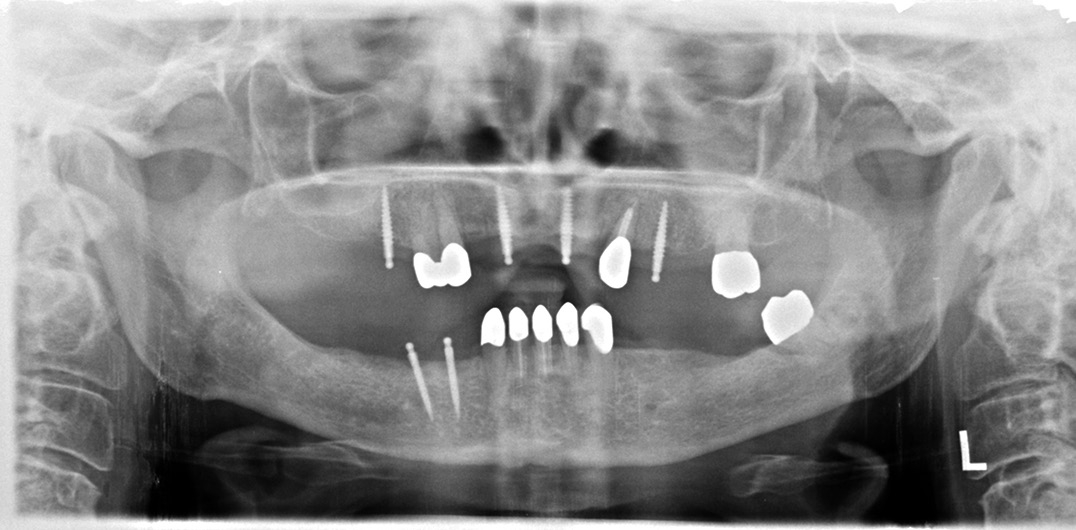 Abb. 4: Befund 2015: Nach Verlust des Zahnes 47 sind zwei Mini-Implantate in regio 43 und 44 hinzugekommen.