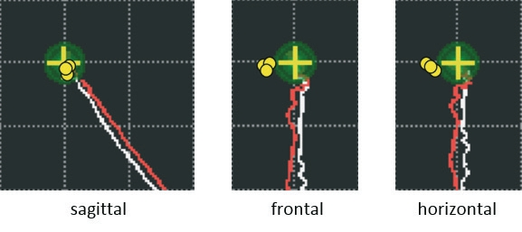 Abb. 6: Verschiedene Kondylenlagen im rechten Kiefergelenk nach Relationsbestimmungen. Die gelben Punkte symbolisieren die auf die Protrusionsbahn projizierten Kondylenlagen. Es handelt sich um eine Menge gleichwertiger Kondylenlagen. Es kann nicht zwischen einer „richtigen“ und einer „falschen“ Lage unterschieden werden. Die Kästchengröße entspricht 1 mm.