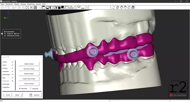 Abb. 7: Softwareseitige Konstruktion einer Anti-Schnarcher-Schiene in der BiteReg-Software.