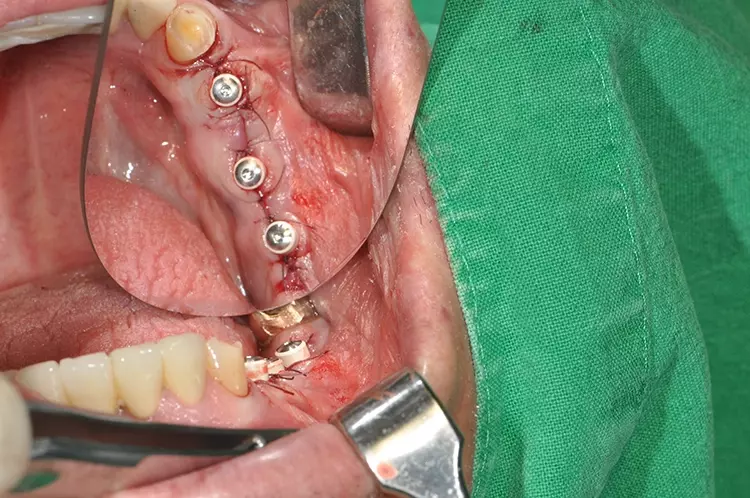 Abb. 7: Abschluss der OP mit Einbringen der Heilungskäppchen.