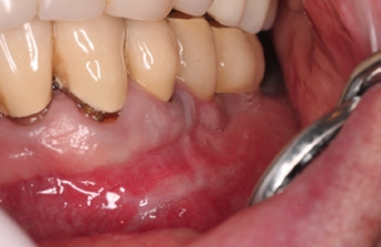 Abb. 8: Zustand sechs Monate postoperativ mit ausreichend befestigter, keratinisierter Gingiva.