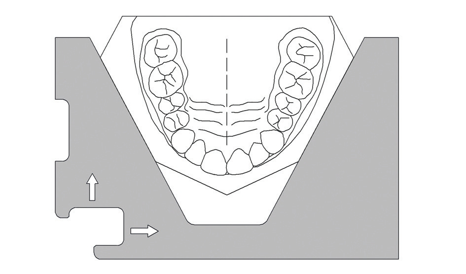 Abb. 7: Schablone zur Aufnahme des Oberkiefermodells.