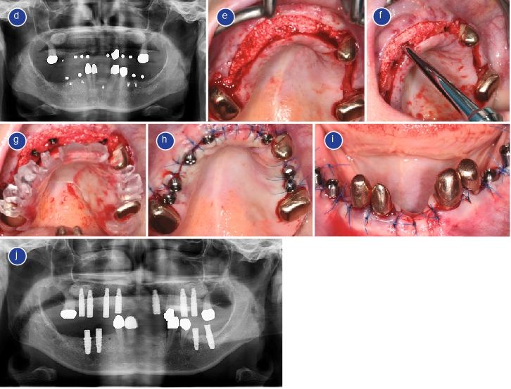 Abb. 7: Zur Vorbereitung der Implantation werden Bohrschablonen gefertigt, für den Oberkiefer (a) und den Unterkiefer (b). Die Okklusion kann überprüft werden (c) und mit einer Röntgenaufnahme werden die Implantatlänge und der -durchmesser neu berechnet. Darstellung des Oberkiefers bei Wiedereintritt, Freilegung des neugewachsenen Knochens (e), in den die Implantate dann unter Verwendung von Osteotomietechniken (f) und der Bohrschablone (g) platziert wurden. Die Nahtsituation im Ober- und Unterkiefer (h und i). Die Unterkieferimplantate wurden analog zum Oberkiefer platziert. Zum Abschluss wurde ein OPG durchgeführt, um die Implantation zu überprüfen (j).