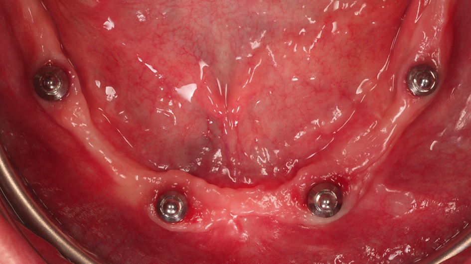 Abb. 8: Zustand nach Befestigung der vier Kugelkopfanker (PS BA).
